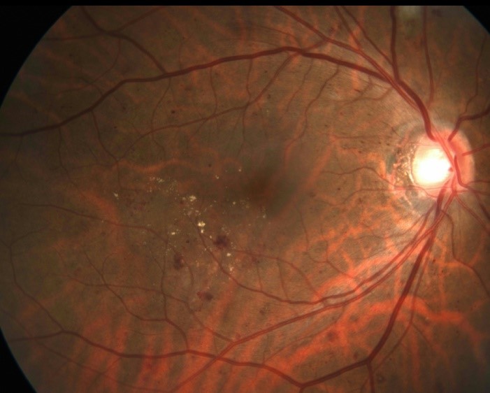 Диабетическая ретинопатия 1.jpg